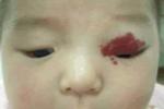 眼部毛細血管瘤 草莓痣 眼部焰色痣 嬰兒型血管瘤