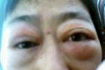眼眶假瘤 H05.804 特發性非特異性眼眶炎