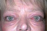 眼眶炎性假瘤