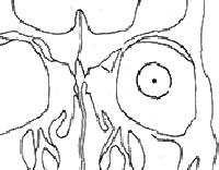 眼內異物 Intraocular foreign bodies