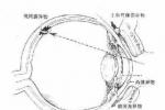 眼內異物 Intraocular foreign bodies