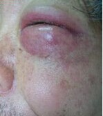 眼眶蜂窩織炎 Orbitalinflammation