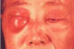 眼眶蜂窩織炎 Orbitalinflammation