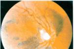 先天性視網膜劈裂 青年性視網膜劈裂癥 先天性玻璃體血管紗膜癥 性連鎖性青年性視網膜分離癥