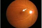 特發性黃斑部前膜 特發性黃斑視網膜前膜 特發性黃斑前膜