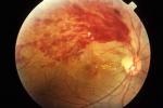 視網膜中央靜脈阻塞 H34.803 