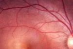 視網膜中央靜脈阻塞 H34.803 
