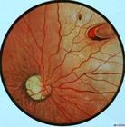 視網膜裂孔