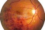 視網膜中央動脈阻塞