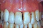 牙齦出血 K06.802 