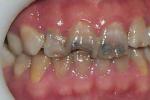 齲齒 K02.901 蛀牙 爛牙 蟲牙 齲病