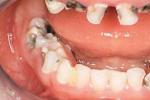 蛀牙 齲齒 齲病 蟲牙 爛牙