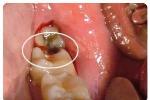 蛀牙 齲齒 齲病 蟲牙 爛牙