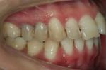 磨牙 磨牙癥 夜磨牙
