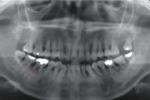 牙周病 K05.501 