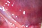舌下腺囊腫 K11.604 蛤蟆腫