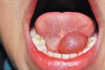 舌下腺囊腫 K11.604 蛤蟆腫