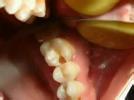 急性牙髓炎 K04.002 Acute pulpitis