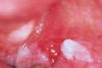 口腔黏膜白斑