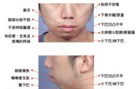 下頜後縮 Mandibular retrusion