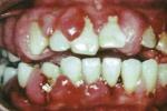 藥物性牙齦增生