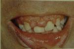 藥物性牙齦增生