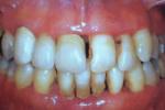 牙周萎縮 牙齦退縮 邊緣組織退縮