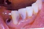 牙髓病 牙髓炎 牙髓壞死 牙髓退變