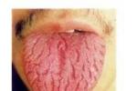 舌病 地圖舌 裂紋舌 毛舌 正中菱舌