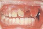 牙折 牙齒折斷