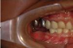 單純性牙周炎 成人牙周炎 牙周炎