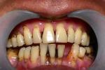 單純性牙周炎 成人牙周炎 牙周炎