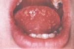 口腔單純性皰疹 原發型皰疹性口炎 原發型皰疹性口炎