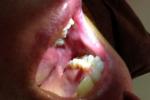 嬰幼兒舌下囊腫