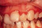 青春期牙齦炎 牙齦炎