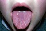 舌乳頭炎