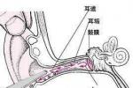 耵聹栓塞 H61.201 