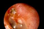 膽脂瘤型中耳炎
