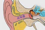 外耳道耵聹腺腫瘤