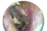 外耳道膽脂瘤 H60.402 外耳道阻塞性角化病 EACC