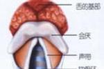 先天性喉喘鳴 Q31.401 喉軟骨軟化