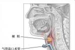 先天性喉軟骨畸形