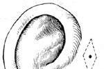 遺傳性耳瘺 耳凹 耳孔