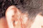 遺傳性耳瘺 耳凹 耳孔