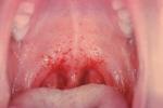 咽部膿腫