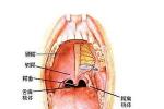 咽部膿腫