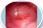 宮頸糜爛 子宮頸炎 erosion of cervix