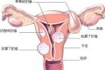 子宮肌瘤 子宮良性腫瘤