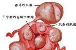 卵巢囊腫 N83.203 