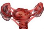 子宮內膜異位癥 子宮腺肌病 內在性子宮內膜異位癥 子宮內膜異位